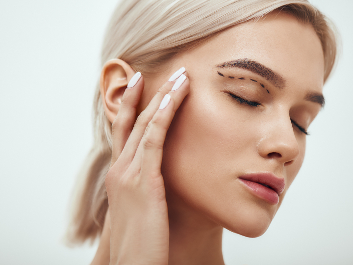 upper blepharoplasty