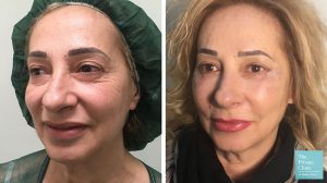 Lower eylid blepharoplasty with fat transfer before after photo