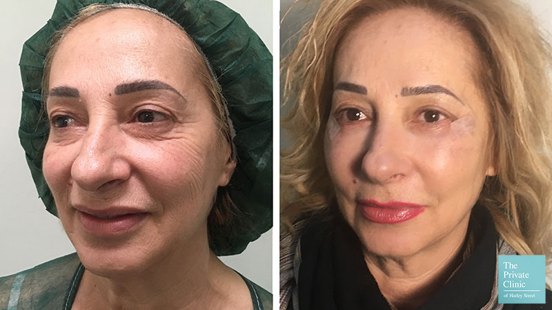 lower eyelid blepharoplasty before after photo