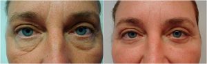 lower blepharoplasty eyelid surgery before after photo