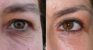 Upper Blepharoplasty eyelid-surgery before after photo