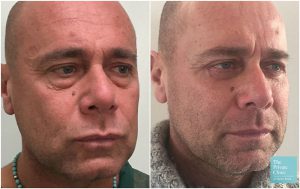 blepharoplasty with fat transfer lower eyelid surgery before after photos