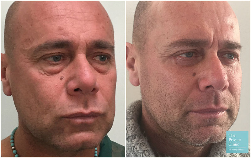 lower blepharoplasty male before after photos