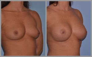 boob job before and after photos