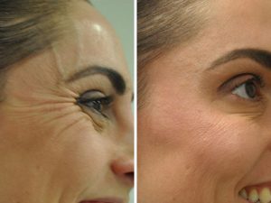 Anti-wrinkle injections to eye lines botox before and after photo