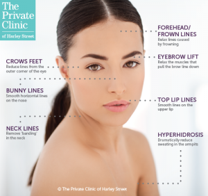 botox face injection best areas sites wrinkle treatment