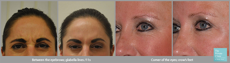 botox wrinkle injections forehead crows feet before after photos