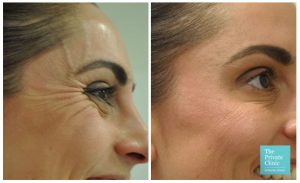 Anti Wrinkle Injections for crows feet, lines around the eyes