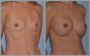 breast augmentation before after pictures