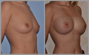 breast augmentation before and after photos