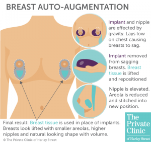 what is breast enlargement auto augmentation surgery