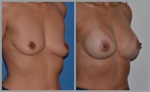 breast enlargement before and after UK