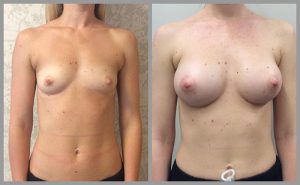 breast enlargement breast augmentation surgery photos