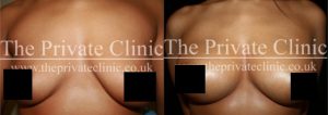 Before and after Breast Fat Transfer, performed at The Private Clinic by Dr. Dennis Wolf. 