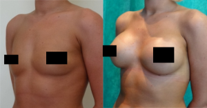 Before and after Breast Augmentation at The Private Clinic. 