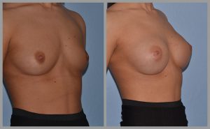 breast implant before and after pictures