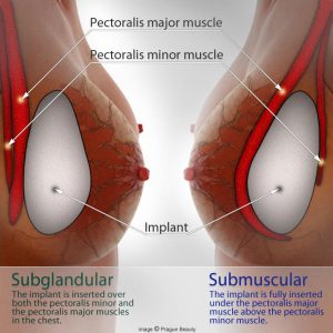 breast implants over under the muscle