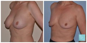 breast implant removal procedure before after photo