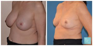 Breast implant removal and uplift before and after photo