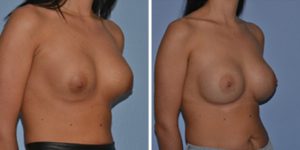 breast implant replacement and removal before after photo