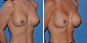 breast implants replacement removal london before after photo