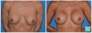 Breast Implant removal replacement UK before after photo