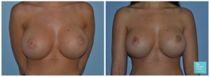 Breast Implant Replacement before after photos