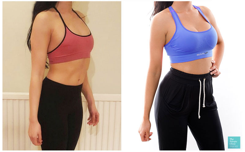 breast implants augmentation buckinghamshire before after photo