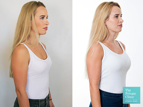 breast enlargement surgery south east England before after photos