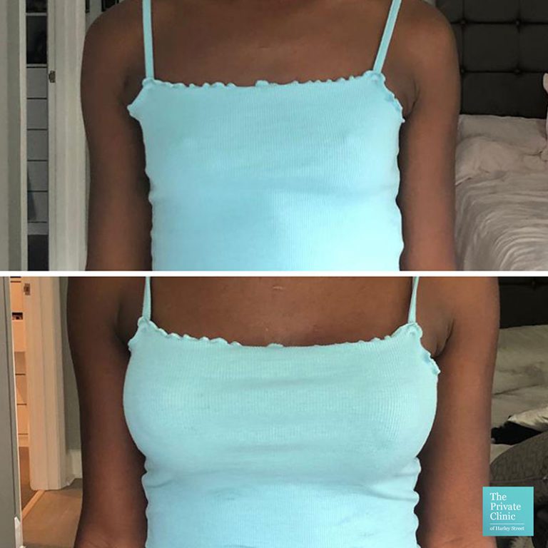 Breast Enlargement Surgery London, Breast Implants UK cost, Before and