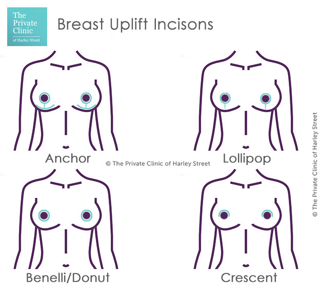 Breast Uplift