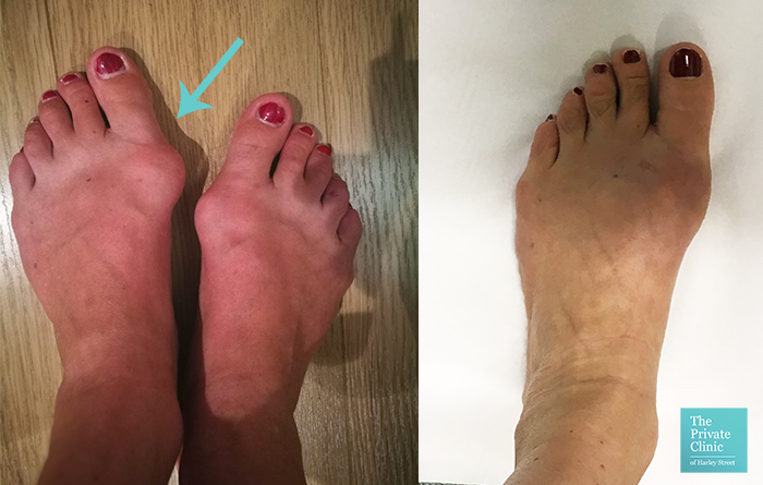 minimally invasive bunion surgery before after photo