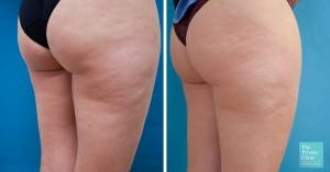 cellulite removal legs before after photo