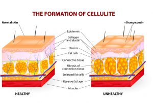 cellulite causes treatment