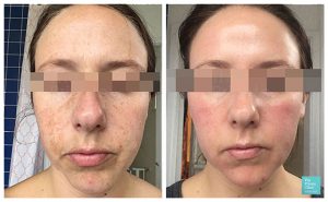 Chemical Skin Peels before after photos UK