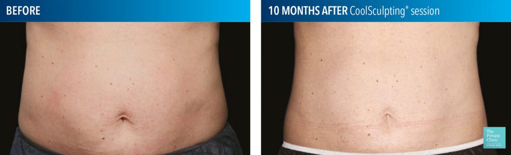 tummy freezing fat cells before after photo