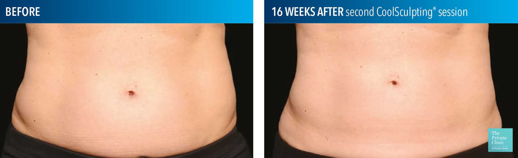 CoolSculpting Before and After Picture of Back Fat and Stomach -  Connecticut Skin Institute