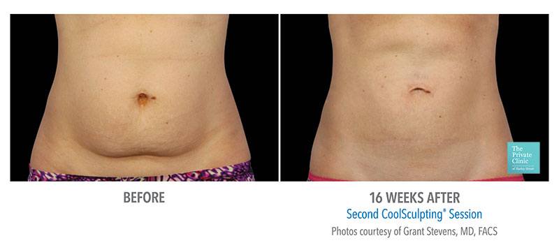 coolsculpting fat freezing abdomen tummy stomach results before after photos