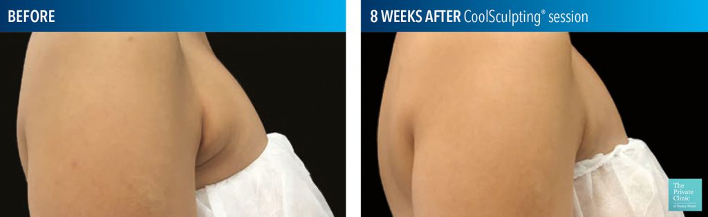 coolsculpting fat freezing bra fat before after photos