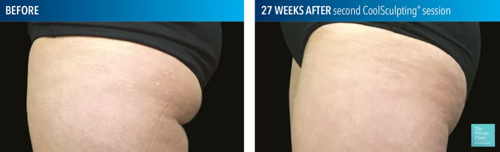 coolsculpting fat freezing buttocks banana roll before after photos