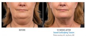 coolsculpting fat freezing double chin before after photos