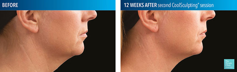 coolsculpting before and after chin photos