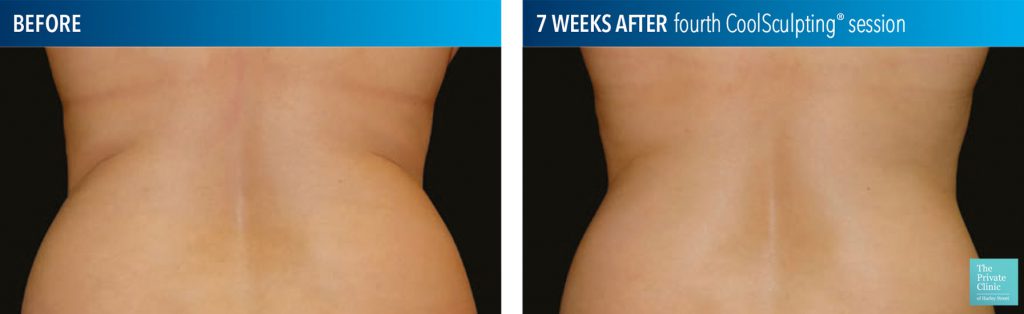 coolsculpting fat freezing flanks before after photos