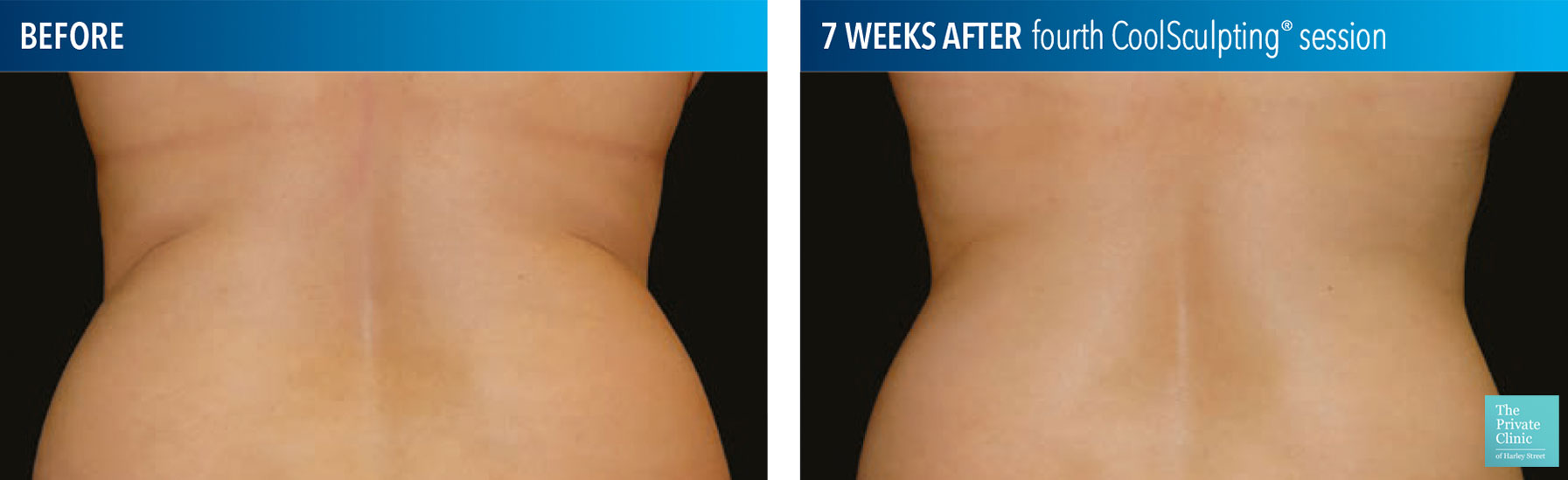 CoolSculpting Fat Freezing Thighs