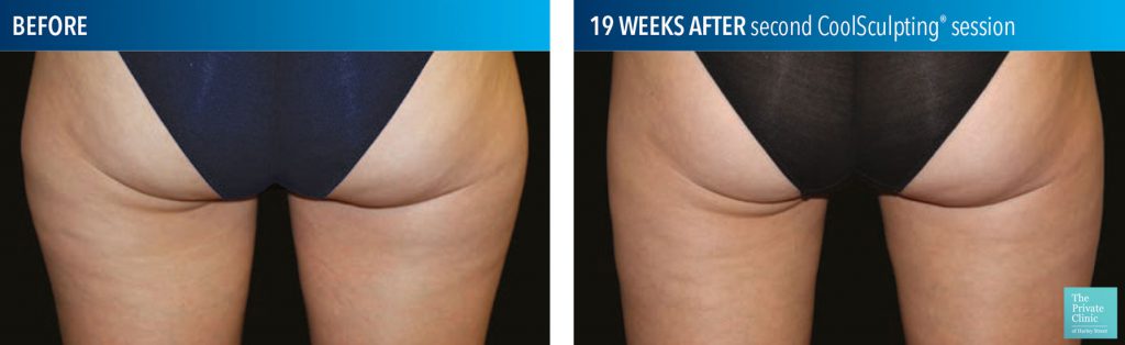 coolsculpting fat freezing thighs before after photos