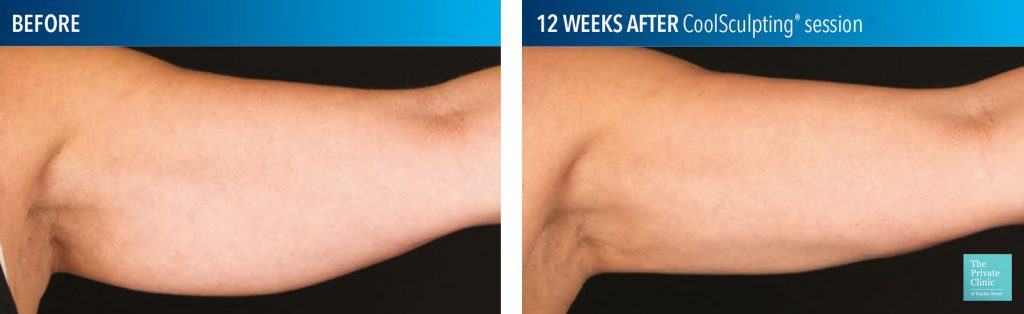 coolsculpting fat freezing upper arm before after photos 