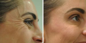 crows feet treatments before after photo