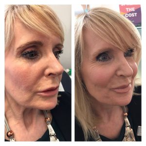 dermal filler cheek filler injections before after photos