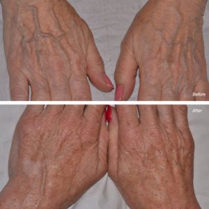 dermal filler injections hands before after photos