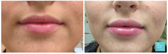 dermal filler near me london before after photo